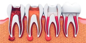 Kanal Tedavisi (Endodonti) Nedir? Nasıl Yapılır?