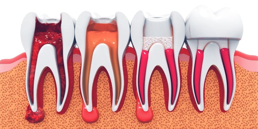 Kanal Tedavisi (Endodonti)