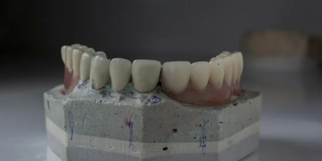 Alçı model üzerinde duran alt çene protezi; protetik diş tedavisinde ölçü ve model aşamasını temsil eden görsel